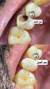 حشوات تجميلية • جلسة واحدة • عيادة المسك