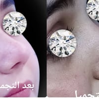 تجميل الأنف • أنف غضروفي • قبل وبعد