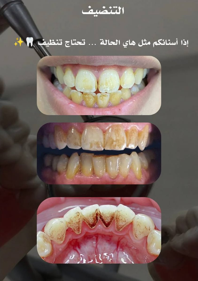 معالجة مجانية • حشوة ضوئية • قلع أسنان