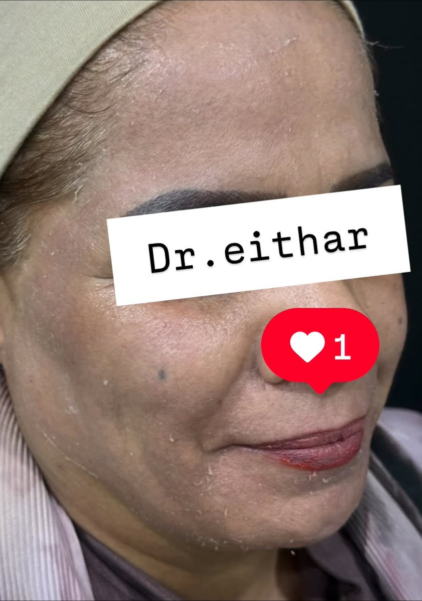 كونتور الوجه بالفلر  (لفتنك وجنات  واصداغ وتدوير الفك والذقن ونظاره وشفة وبوتوكس ) 🔥🔥
لاحضو الفرق بالذقن ومنطقه الفك   شكد تغير الشكل🔥
عروووض للكادر التدريسي والخريجات والموظفات والعروسات  ثبتتهه الكم بالستوري بالهايلايت وببوست اعلى الصفحة ✨✨

د.ايثار سامي عبد الامير
واسط الكوت الهوره مجمع القبطان طابق اول 

الحجز***********

نص مكتوب في الصور:
- Dr.eithar 1