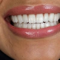 تجميل أسنان • تصميم ابتسامة • المناذرة النجف