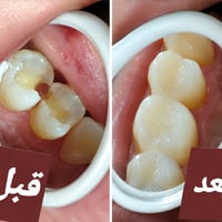 مشيرفة شارع 60 • تغليف أسنان • زراعة وتقويم