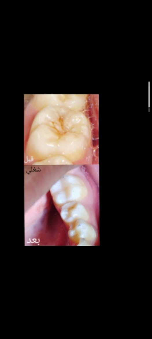 علاج مجاني
السلام عليكم ورحمة الله وبركاته للمرضى الاعزاء يتوفر لدينا :-
قلع سن و بقايا الجذور.
حشوات اسنان. 
طقم اسنان جزئي أو كامل.
 تنظيف الاسنان من التكلسات.
تقويم اسنان.
علاج مفصل الفك.
تشخيص امرض الفم.
علاج صرير و طحن الاسنان اثناء النوم بستخدم الحارس الليلي.

مجاني في  عيادات جامعة النور التخصصية لطب الاسنان بإشراف الدكاترة المتخصصين في طب الاسنان الاستفسارات والأسئلة العامة الاتصال على الرقم التالي :
***********
الدكتور واثق عبدالله حسن

نص مكتوب في الصور:
- 8:15 34 قلع سن العقل Extraction of wisdom tooth A+ بعد done without complications time for extraction 1m to 3m finally grade by doctor : A+ شغلي
- قبل شغلي بعد