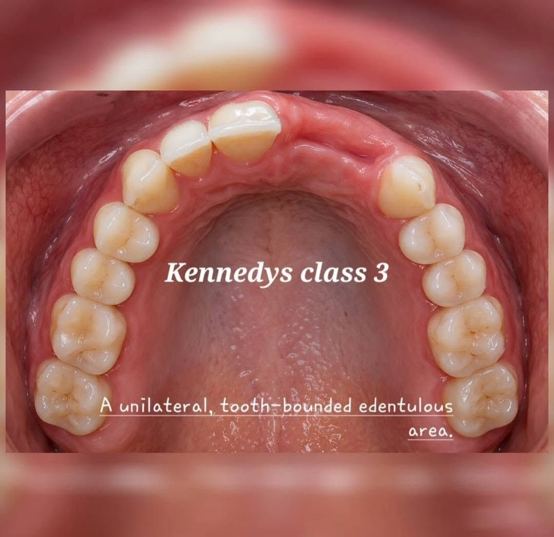 ⚠️اضرار عدم تعويض الأسنان المفقودة بطقم جزئي متحرك ⚠️
🦷 1. تحرك الأسنان المجاورة
عند فقدان سن وعدم تعويضه بطقم جزئي متحرك، تبدأ الأسنان المجاورة بالميلان نحو الفراغ مع مرور الوقت، مما يسبب اضطرابًا في ترتيب الأسنان ويجعل تنظيفها أكثر صعوبة.

🍽️ 2. صعوبة المضغ
غياب الأسنان يقلل من كفاءة المضغ، فيضطر الشخص لاستخدام جهة واحدة فقط، مما قد يسبب إجهادًا للفك ويؤثر في عملية الهضم بسبب عدم مضغ الطعام جيدًا.

🦴 3. تآكل عظم الفك
بعد فقدان السن يبدأ العظم الذي كان يدعمه بالانكماش تدريجيًا نتيجة غياب التحفيز أثناء المضغ، وقد يؤدي ذلك إلى تغير شكل اللثة والفك مع الوقت.

😬 4. اضطراب الإطباق (العضة)
قد يتحرك السن المقابل للفراغ أو زحف الأسنان المجاورة، مما يؤدي إلى خلل في العضة، وقد يسبب صعوبة في إغلاق الفم بشكل طبيعي أو الشعور بعدم الراحة أثناء المضغ.

🗣️ 5. التأثير على النطق والمظهر
فقدان الأسنان، خصوصًا الأمامية، قد يؤثر في نطق بعض الحروف ويغير الابتسامة، مما قد يقلل من ثقة الشخص بنفسه أثناء الحديث أو الابتسام.

⚠️ 6. زيادة الضغط على الأسنان المتبقية
عندما تقل الأسنان التي تتحمل قوة المضغ، يزداد الحمل على الأسنان المتبقية، مما قد يعرضها للتآكل أو الكسر أو مشاكل في اللثة على المدى الطويل.

👩🏻‍⚕️ملاحظة للمتابعين

أنا كطالبة في كلية طب الاسنان - جامعة آوروك الاهلية/ Uruk private university - college of dentistry 
أقدم علاج تعويض الأسنان المفقودة بطقم جزئي متحرك ((مجانًا دون دفع أي مبلغ)) ضمن برنامج التدريب الأكاديمي، بإشراف أطباء اسنان متخصصين، وذلك يشمل:

. جميع حالات الاسنان المفقودة في الصور ادناه👇🏻

الغرض أكاديمي، بشكل مجاني بشرط الالتزام بالتعليمات و بمواعيد الجلسات القادمة.

للاستفسار و الحجز مراسلة من خلال رقم الواتس اب 👇🏻
📞***********
