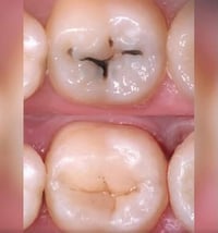 مجاناً • طبيب اسنان • حشوات و قلع