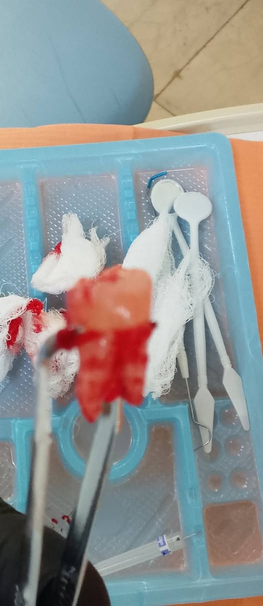 جامعة الزهراوي • علاج مجاني • اطفال تحت ١٥