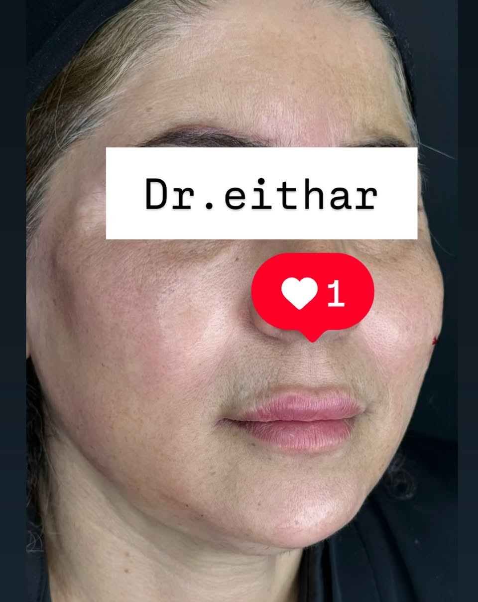 تجديد شد الوجه بالفلر  (لفتنك وجنات  واصداغ وتدوير الفك والذقن ونظاره وشفة سابقا حاقنتهه قبل سنه مجددناه لان متحتاج  ونظاره وبوتوكس  ) 🔥🔥🔥

اتمددت عروووض للكادر التدريسي والخريجات والموظفات والعروسات لنهايه الاسبوع ليوم الاربعاء اخر يوم  ثبتتهه الكم بالستوري بالهايلايت وببوست اعلى الصفحة ✨✨

د.ايثار سامي عبد الامير
واسط الكوت الهوره مجمع القبطان طابق اول 

الحجز***********

نص مكتوب في الصور:
- Dr.eithar
- 1
- Dr.eithar 1