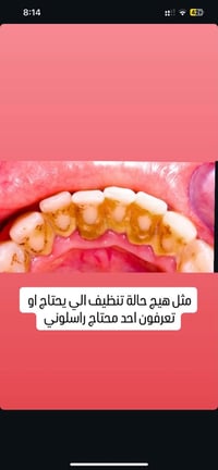 تنظيف أسنان • جامعة الشرق الاوسط • الاثنين