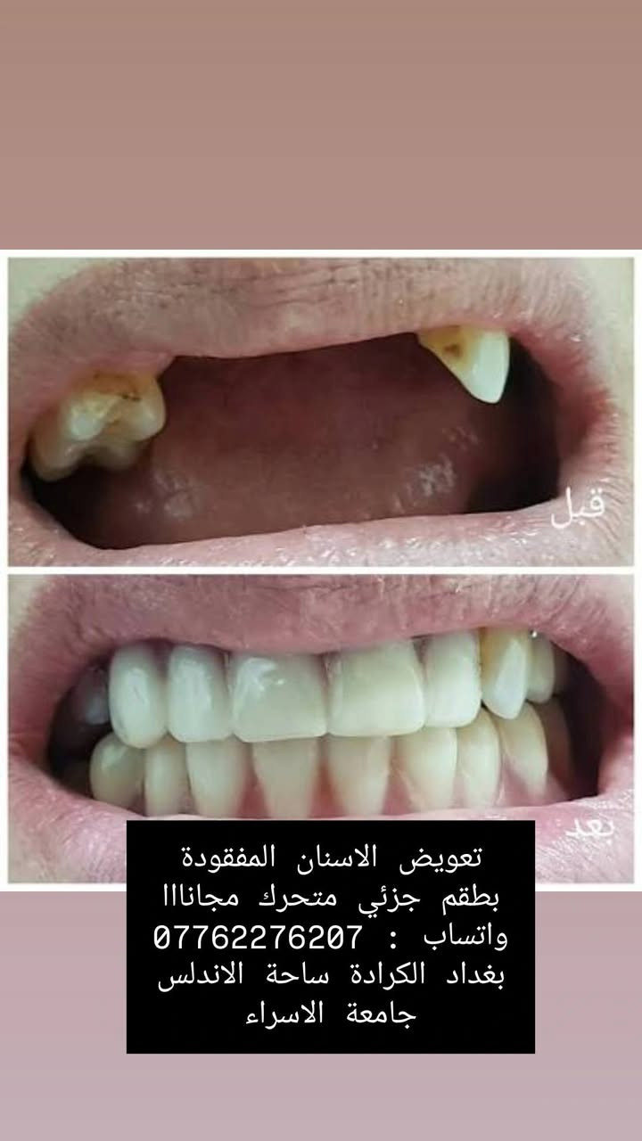 قلع جذور مجاني • حشوة مجانية • بغداد الكرادة