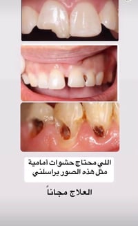 علاجات سنية مجانية • عيادات جامعة المنارة • قلع وحشوات