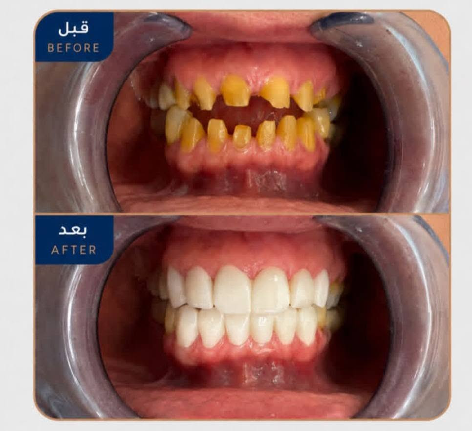 كلما چنت أريد أضحك.. چنت أغطي حلگي بـإيدي.."
في عيادتنا، ما نغير شكل الأسنان بس.. إحنا نغير جودة حياة مراجعينا ونرجع لهم الأمل.

لأن راحتكم تهمنا.. الابتسامة صارت بالتقسيط!

​💡 قصتك القادمة تبدأ بقرار.. لا تخلي التكلفة تأجل ضحكتك، 
​📞 احجز موعدك الآن واصنع قصتك الخاصة:
​
​رقم الواتساب / الهاتف: [ *********** ]
​أو ارسل لنا رسالة مباشرة على بريد الصفحة 📩
​#قصص_النجاح #طب_أسنان #ابتسامة_جديدة #مصرف_الرافدين #تسهيلات_دفع #أقساط #العراق
