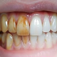 تنظيف أسنان • قلع وحشوات • علاج مجاني