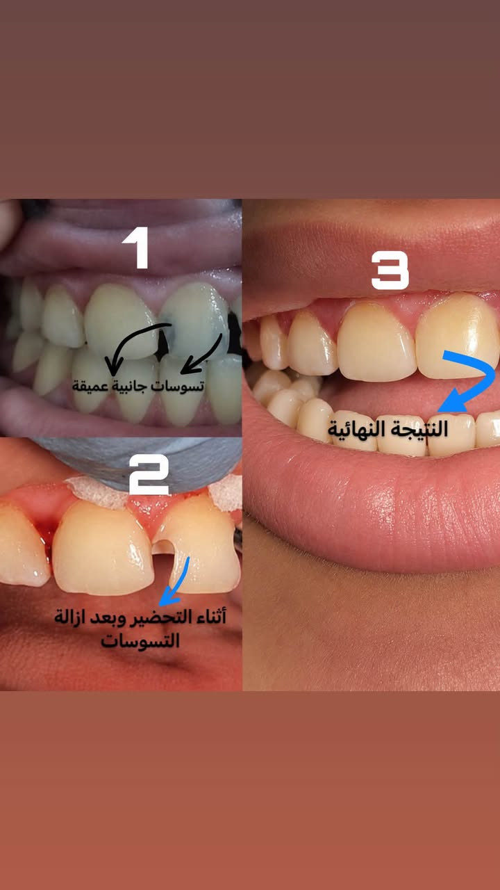 السلام عليكم الي يحب يحجز متواجدين من يوم السبت القادم
(*********** واتس اب)

( او مراسلتي على الخاص )

اترك لكم بعض الحالات الي اشتغلتها خلال السنة السابقة وتحياتي.

نص مكتوب في الصور:
- بعد After تصبغات قبل Before
- قبل Before تكلسات قديمة بعد After
- 1 تسوس 2 أثناء التحضير 3 النتيجة النهائية
- Before After قبل بعد
- 1 تسوسات جانبية عميقة 2 أثناء التحضير وبعد ازالة التسوسات 3 النتيجة النهائية
