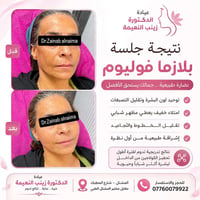 بلازما فوليوم • نضارة • امتلاء طبيعي