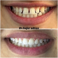 إغلاق فراغات • تقويم أسنان • ابتسامة متناسقة