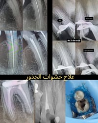 فرصة علاج الأسنان في عيادات الجامعة الأمريكية فحص وتشخيص الاسنان حشوات...