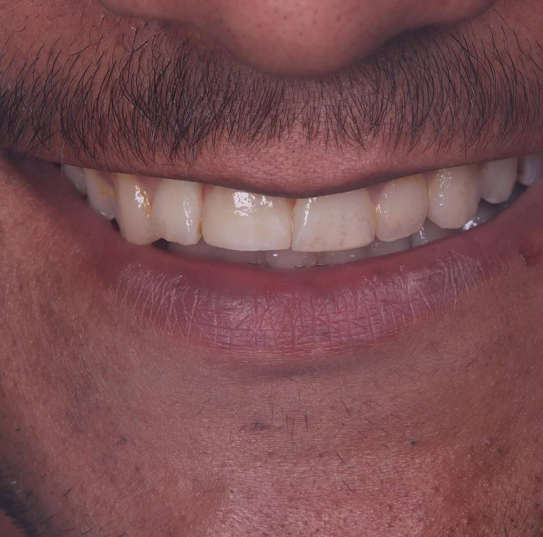 كلما چنت أريد أضحك.. چنت أغطي حلگي بـإيدي.."
في عيادتنا، ما نغير شكل الأسنان بس.. إحنا نغير جودة حياة مراجعينا ونرجع لهم الأمل.

لأن راحتكم تهمنا.. الابتسامة صارت بالتقسيط!

​💡 قصتك القادمة تبدأ بقرار.. لا تخلي التكلفة تأجل ضحكتك، 
​📞 احجز موعدك الآن واصنع قصتك الخاصة:
​
​رقم الواتساب / الهاتف: [ *********** ]
​أو ارسل لنا رسالة مباشرة على بريد الصفحة 📩
​#قصص_النجاح #طب_أسنان #ابتسامة_جديدة #مصرف_الرافدين #تسهيلات_دفع #أقساط #العراق
