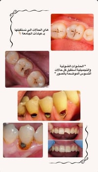 علاج مجاني • عيادات جامعة الحله • حشوات ضوئية