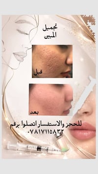 جلستين • ليزر • إزالة تشوهات