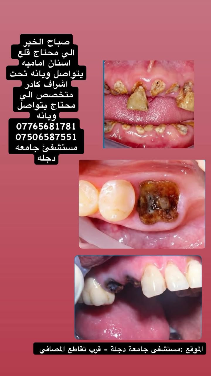 🦷 عندك مشكلة بأسنانك وتحتاج علاج؟

نستقبل حاليًا حالات علاج الأسنان مجانًا، وتشمل:

▫️ الحشوات الضوئية
▫️ قلع الأسنان وبقايا الجذور
▫️ تنظيف الأسنان وإزالة الجير والتصبغات
▫️ تعويض الأسنان المفقودة

👩🏻‍⚕️ يتم تقييم الحالة قبل العلاج، والعمل تحت إشراف أطباء اختصاص.

📍 بغداد، الدورة، شارع المصافي، عيادات كلية دجلة

📩 للحجز والاستفسار: ***********

***********

إذا تعرف شخص يحتاج علاج، شاركه المنشور 🤍🦷

نص مكتوب في الصور:
- DUCOD College Of Dentistry 2004 د. عبدالله فارس ستار كلية طب الأسنان - جامعة دجلة العلاج مجاني بإشراف أطباء اختصاص الخدمات المتوفرة تنظيف وتلميع الاسنان حشوات ضوئية طقم جزئي متحرك قلع الجذور المتبقية و الاسنان التواصل *********** *********** @dr_abdullah_fares @1_ym0 *********** كلية طب الاسنان - جامعة دجلة - الدورة - قرب تقاطع المصافي
- صباح الخير الي محتاج علاج التسوس و حشوة تجميلية يتواصل ويانه تحت اشراف كادر متخصص الي محتاج يتواصل ويانه *********** *********** مستشفي جامعه دجله علاج تسوس الاسنان بحشوات تجميلة الموقع: مستشفى جامعة دجلة - الدورة - قرب تقاطع المصافي
- صباح الخير الي محتاج تنظيف اسنان يتواصل ويانه تحت اشراف كادر متخصص الي محتاج يتواصل ويانه *********** *********** مستشفى جامعه دجله تنظيف وازالة التصبغات الموقع : مستشفى جامعة دجلة - الدورة -قرب تقاطع المصافي
- صباح الخير الي محتاج قلع اسنان اماميه يتواصل ويانه تحت اشراف كادر متخصص الي محتاج يتواصل ويانه *********** *********** مستشفى جامعه دجله الموقع :مستشفى جامعة دجلة - قرب تقاطع المصافي
- اهلا من الاسبوع الجاي راح نبدي نشتغل بعياداتنا تحت اشراف اطباء وكادر طبي متخصص
- لهذه الحالات الي راح اذكرها الي سالوني راسلوني احجز لكم موعد
- قلع الاسنان والجذور المتبقية:
- تعويض الاسنان المفقودة بطقم متحرك:
- الحشوات الضوئية وتكون بلون السن الاصلي:
- Before
- After
- تنظيف الاسنان وازلة البقع والتكلسات: