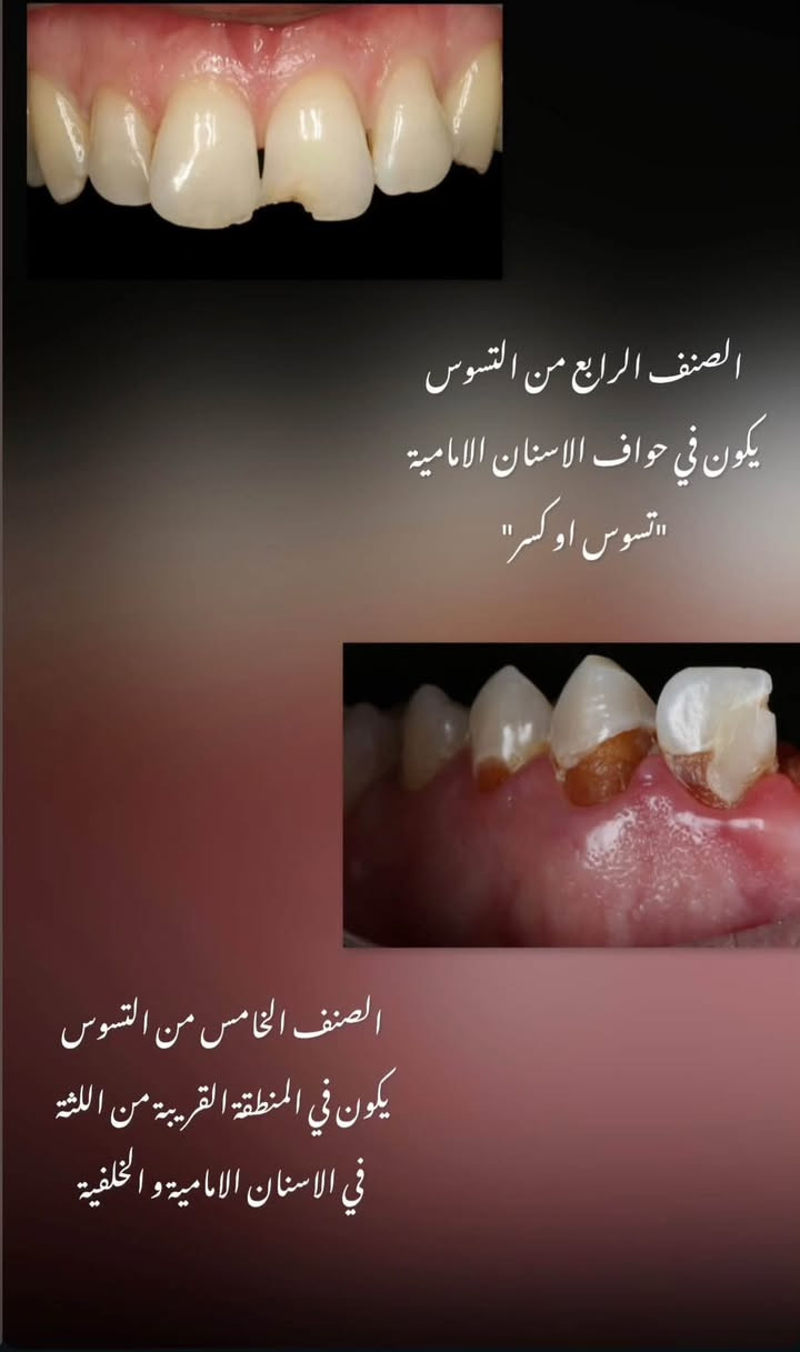 السلام عليكم نستقبلكم لعلاج الحالات الاتية علماً ان العلاج يتم بشكل مجاني تحت اشراف افضل الاطباء وذوي خبرة على مستوى المحافظة اي شخص عنده سن حاب يقلعه او جذور او يريد يسوي حشوة او تنضيف يتواصل مع الرقم ويتدلل العنوان واسط جامعة الكوت (الي صايرة على طريقة الحي) والي يحب يشوف الشغل يدخل على الصفحه علمود يشوف الحالات الي اشتغلنا باعلى كفاءة ولله الحمد

***********

نص مكتوب في الصور:
- اسنان تالفة وجذور متبقية
- الصنف الرابع من التسوس يكون في حواف الاسنان الامامية "تسوس او كسر" الصنف الخامس من التسوس يكون في المنطقة القريبة من اللثة في الاسنان الامامية والخلفية
- تراكم تكلس الاسنان "الجير" مثل هالحالات