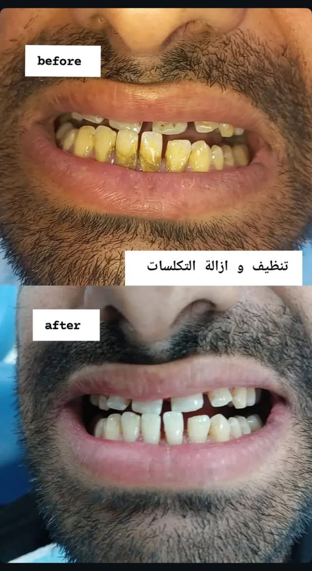 سلام عليكم
اني طالبة طب اسنان مرحلة خامسة 
نشتغل جميع حالات 
حشوات ضوئية 
قلع 
طقم اسنان 
تنظيف و إزالة التكلسات 
و العلاج مجاني و تحت إشراف أطباء مختصين 
العنوان عيادات جامعة البيان 
للحجز راسلوني

نص مكتوب في الصور:
- before
- after
- Before After
- before تنظيف و ازالة التكلسات after
- عيادات جامعة البيان
- د. زينب محمد
- - قلع الأسنان
- - حشوات (معدنية و ضوئية)
- - تنظيف الأسنان و أزالة التكلسات
- - طقم جزئي متحرك
- العلاج مجاني
- و تحت إشراف أطباء مختصين
- ***********
- بغداد -شارع المطار
- قرب ساحة عباس بن فرناس - مجاور الجامعة الأمريكية