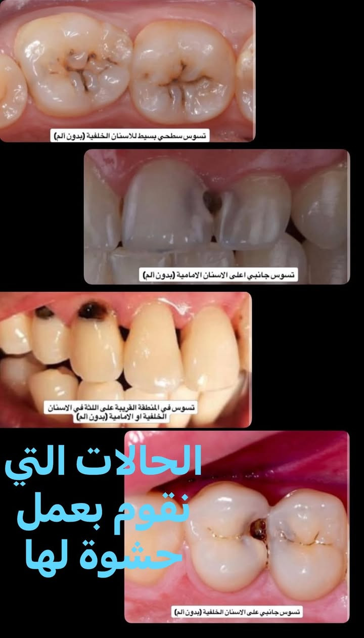 علاج مجاني • قلع أسنان • حشوة ضوئية