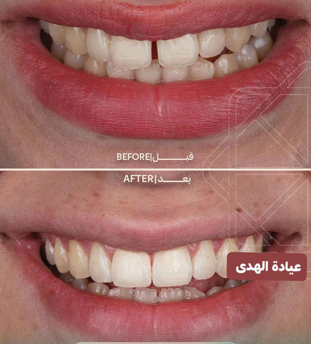 عيادة الهدى لطب الأسنان والتجميل

تقاطع الجدوع مجاور عالم الحليب

***********

اهلا وسهلا بزبائنا الاعزاء

متواجدين يوميا من ٤ عصرا إلى ٩ مساء

نص مكتوب في الصور:
- عيادة الهدى
- BEFORE | قبل AFTER | بعد عيادة الهدى
- BEFORE | قبل
- AFTER | بعد