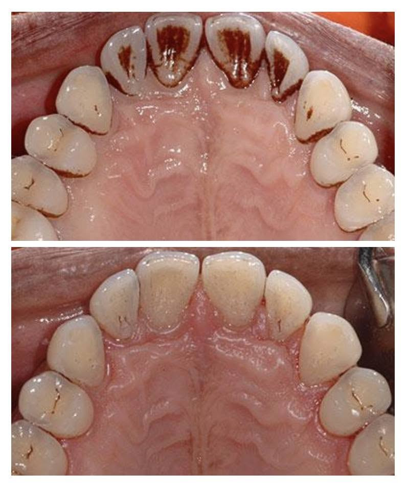 🦷🤍 علاج أسنان مجاني 🤍🦷
السلام عليكم ❤️

 نستقبل مرضى للعلاجات التالية مجاناً ✨

🦷 قلع الاسنان و جذور الأسنان المتبقية
🦷 الحشوات الاعتيادية
🦷 تنظيف الأسنان وإزالة الترسبات
🦷 الأطقم الجزئية المتحركة

📍 المكان: جامعة المشرق – خدمي المطار ✈️

📞 للحجز والاستفسار: ***********

إذا تحتاجون أي علاج من هاي العلاجات أو تعرفون أحد يحتاج، لا تترددون بالتواصل ويانه ❤️

[علما ان العلاج تحت اشراف اطباء مختصين] 

🩷 ابتسامتكم تستاهل العناية! 🦷✨
