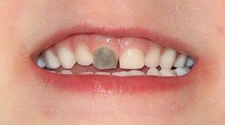 علاج أسنان أطفال • مجاني • كلية طب الأسنان