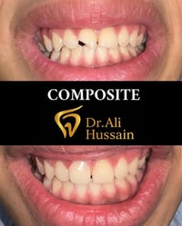 علاج مجاني • ترميم تجميلي • كسر سن أمامي