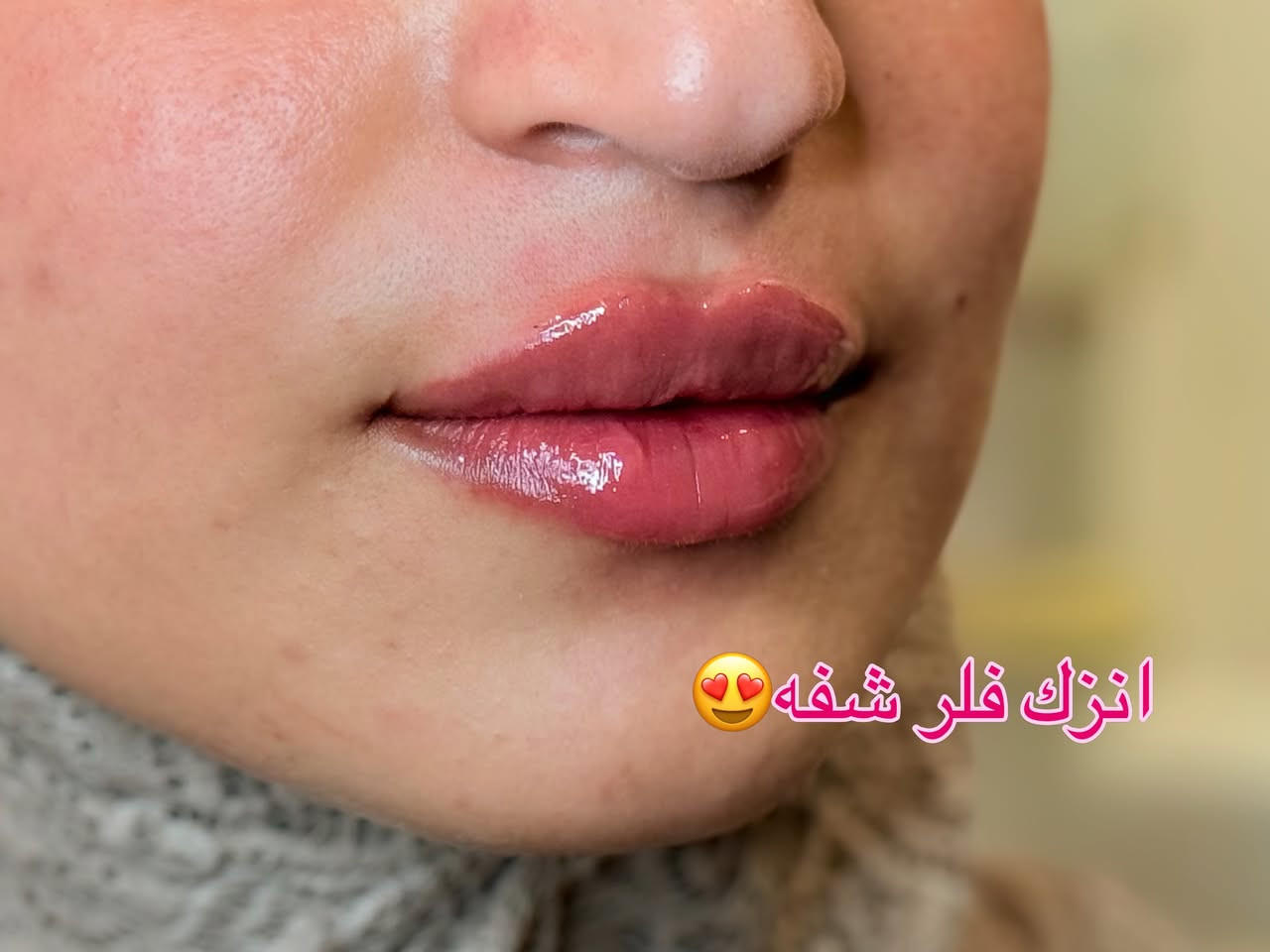 انزك شفه بنص سيسي بس حسب طلب المراجعه لكل البنات الي يحبون الفلر البسيط والناعم هاي احلى رسمه لان أغلبكم تتخوفون انو الفلر يكون اوفر بس نكدر نحصل ع هيج نزاكه 😍🤩🤩
دكتوره فيد موفق للحجز والاستفسار *********** 
حي المعلمين مقابل الجامع الأصفر ❤️‍🔥

.

.
#اكسبلور_فولو #اكسبلورر #فولو #الشعب_الصيني_ماله_حل😂😂
