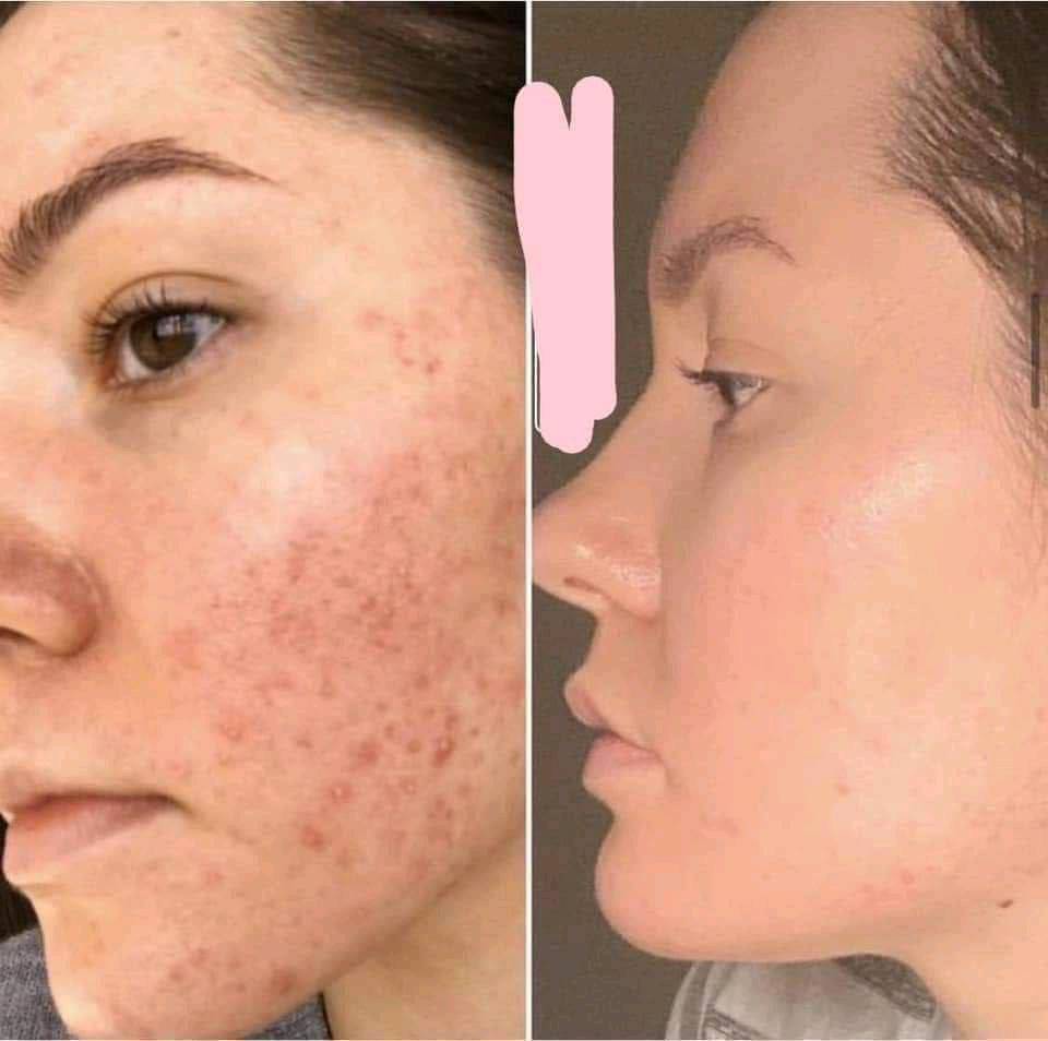 ‏ La roche - posay 
‏🌟 Retinol B3 Serum 🌟
▪️سيروم ريتينول من شركة لاروش الفرنسية 🇫🇷 مضاد لعلامات تقدم السن للوجه والرقبة ..

من افضل السيرومات الريتينول الي تحارب التجاعيد وتعالج علامات تقدم سن البشرة ✔️ يستخدم للتجاعيد العميقة وللبشرة الغير متساوية ..
✔️ يستخدم ريتنول لتقدم سن البشرة الناتج عن اشعة الشمس .. 
✔️ يعمل على شد البشرة ..
✔️ يجعل من البشرة تبدو انعم واكثر صحية ونظره ومشرقة ويعمل على تجديد خلاياها ..
✔️ ترطيب 🌟 ..
✔️ مناسب للبشرة الحساسة ..
 
🌸 يتكون من الريتنول وهو الجزىء الاساسي بهذا المنتج يستهدف التجاعيد العميقة مدموج مع فيتامين B5 لتحسين 
حاجز البشرة وتلطيفها وللحصول على افضل نتيجة 🌸 يحتوي على الNiacinamide الذي يعمل على تقليل من تحسس البشرة وينطي اشراق للبشرة .
المنشأ فرنسي 🇫🇷 
السعر 25 الاف مع توصيل جميع المحافظات العراق مجاني