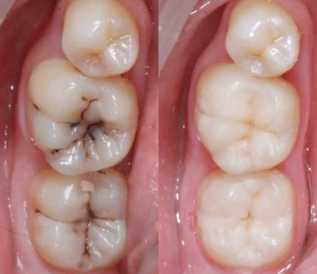 الفحص والعلاج مجاناً 
وتحت إشراف دكاترة مختصين وباستخدام أحدث الأجهزة والتقنيات.
حشوات وقلع وتنظيف و تعويض الاسنان المفقودة 

📍 كربلاء – عيادات كلية الأمل
📍 قرب مستشفى الكفيل
📩 للمهتمين يرجى التواصل على الخاص وحجز موعدكم او واتساب  ***********
