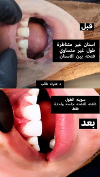 جلسة واحدة • تجميل أسنان • الديوانية