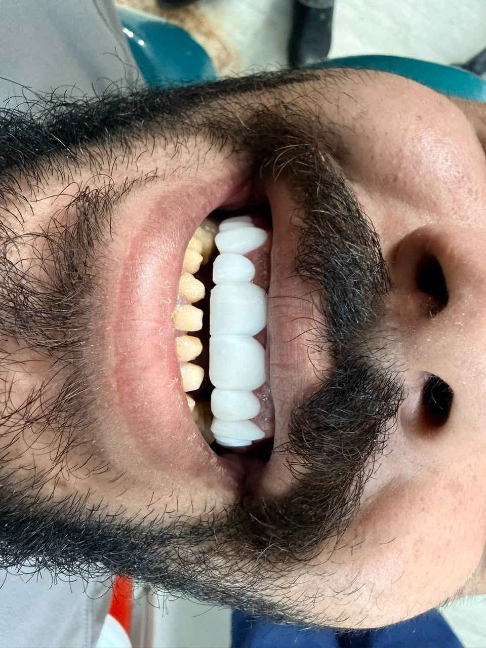 تعلن عيادة بلاتين لطب الأسنان و التجميل عن خصومات بنسبه ٤٠ ٪؜ لفترة محدوده 🎉🎉
تخفيضات على الفلر و البوتوكس و ابر النضاره 

تخفيضات على كافه انواع الابتسامات و الزراعه و الحشوات و تنظيف الاسنان

للاستفسار و الحجز على الرقم 

 ***********
***********

العنوان : شارع شهداء البياع العام -مقابل مطعم دجاج العبيدي- مجمع بلاتين التخصصي
