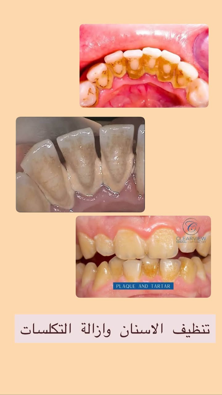 علاج مجاني • عيادات جامعة البيان • قلع اسنان