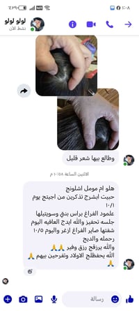 علاج الثعلبة • جلسة تحفيز • بنوته