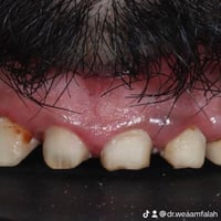 أطقم أسنان • أشا كلينك • الرمادي الإسكان