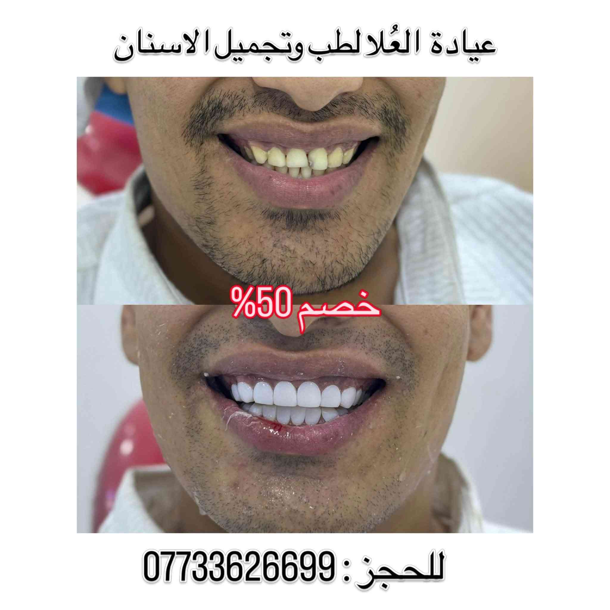 خصم ٥٠٪ • ابتسامة هوليوود • الشرطة الخامسة