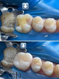 جلسة واحدة • حشوة ضوئية • بابل القاسم