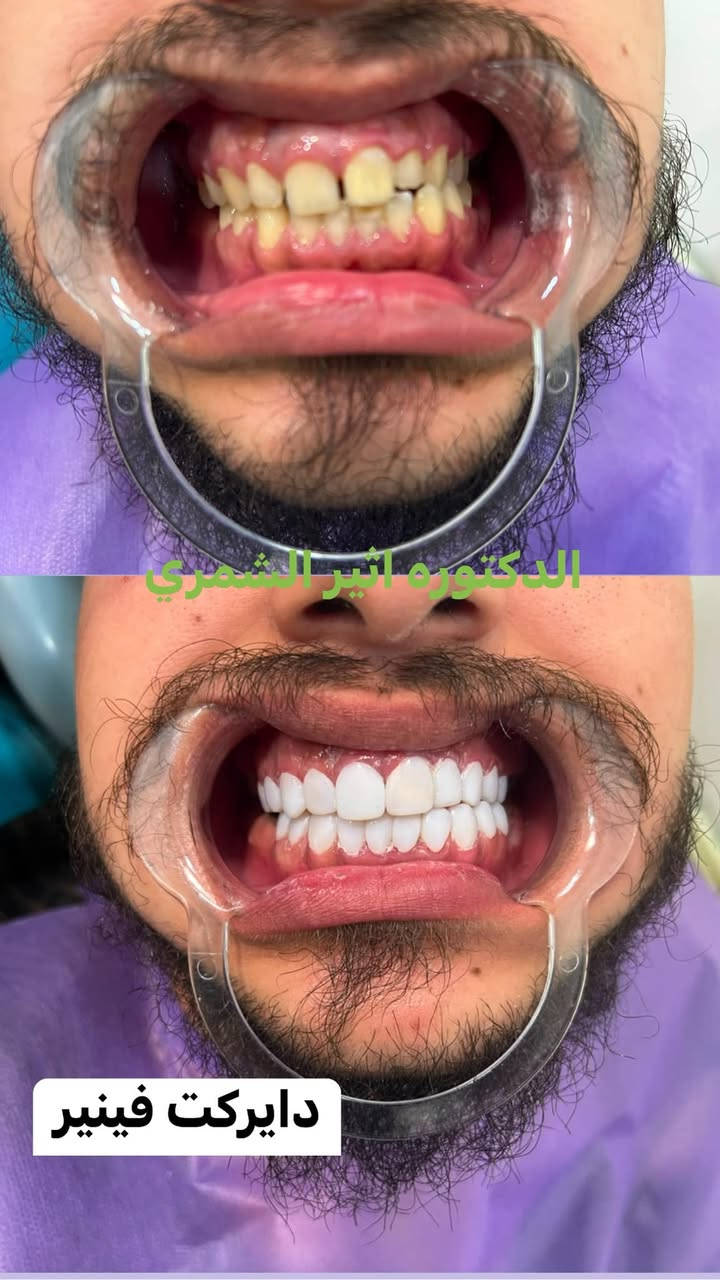 ابتسامتك المتألقة تبدأ من هنا! ✨
في عيادة الدكتورة أثير الشمري لطب وتجميل الأسنان، نمنحك الابتسامة التي تطمح إليها بأعلى معايير الدقة والجودة الطبية 💎
نمزج بين الخبرة الطبية وأحدث التقنيات لنقدم لك أفضل الخدمات:
🦷 ابتسامة هوليود وابتسامة الفينير المباشر (Composite Veneers)
🦷 تغليف وزركونيا الأسنان (Zircon Crowns)
🦷 تقويم الأسنان الشفاف (Clear Aligners)
🦷 زراعة وتجميل الأسنان بأحدث الأجهزة
🦷 تنظيف، تبييض، وعلاج الأسنان المتكامل
دع ابتسامتك تعبّر عن ثقتك! احجز استشارتك اليوم معنا.
📍 العنوان: [حي العدل/شارع الاسواق/مجاور لحوم رسول العنبر]
📞 للحجز والاستفسار: [***********]

نص مكتوب في الصور:
- د.اثير الشمري
- د. اثير الشمري
- الدكتوره اثير الشمري دايركت فينيير
