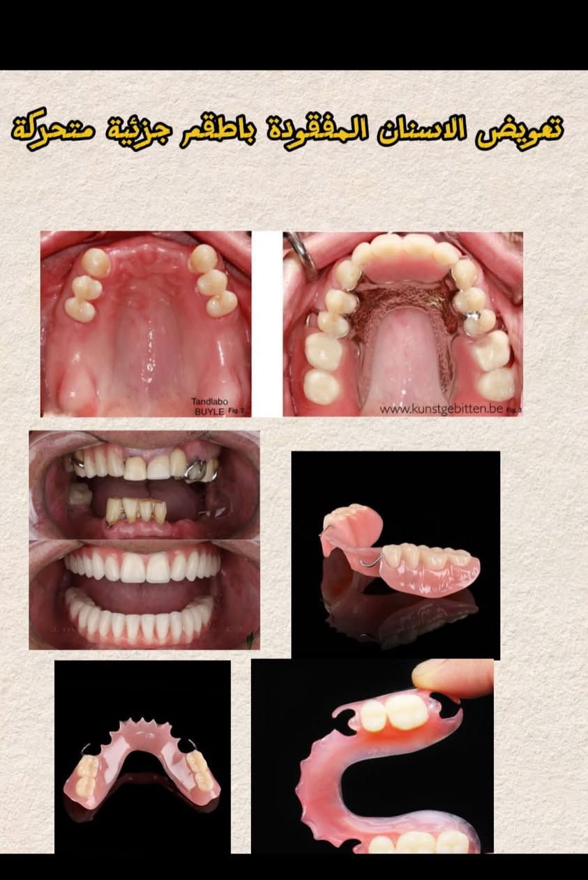 السلام عليكم الي محتاج قلع اسنان او تنظيف او حشوات ضوئية او تركيب طقم متحرك راح يكون العلاج بشكل مجاني وتحت اشراف اطباء اختصاص في محافظة البصرة في عيادات الكنوز التعليمية في الجبيلة للتواصل :
حساب الانستكرام Zainab.razzaqi 
للتواصل واتساب : ***********

نص مكتوب في الصور:
- تنظيف الاسنان وازالة التكلسات
- معالجة التسوس بحشوات دائمة BEFORE AFTER
- تعويض الاسنان المفقودة باطقم جزئية متحركة
- قلع الاسنان وبقايا الجذور التالفة