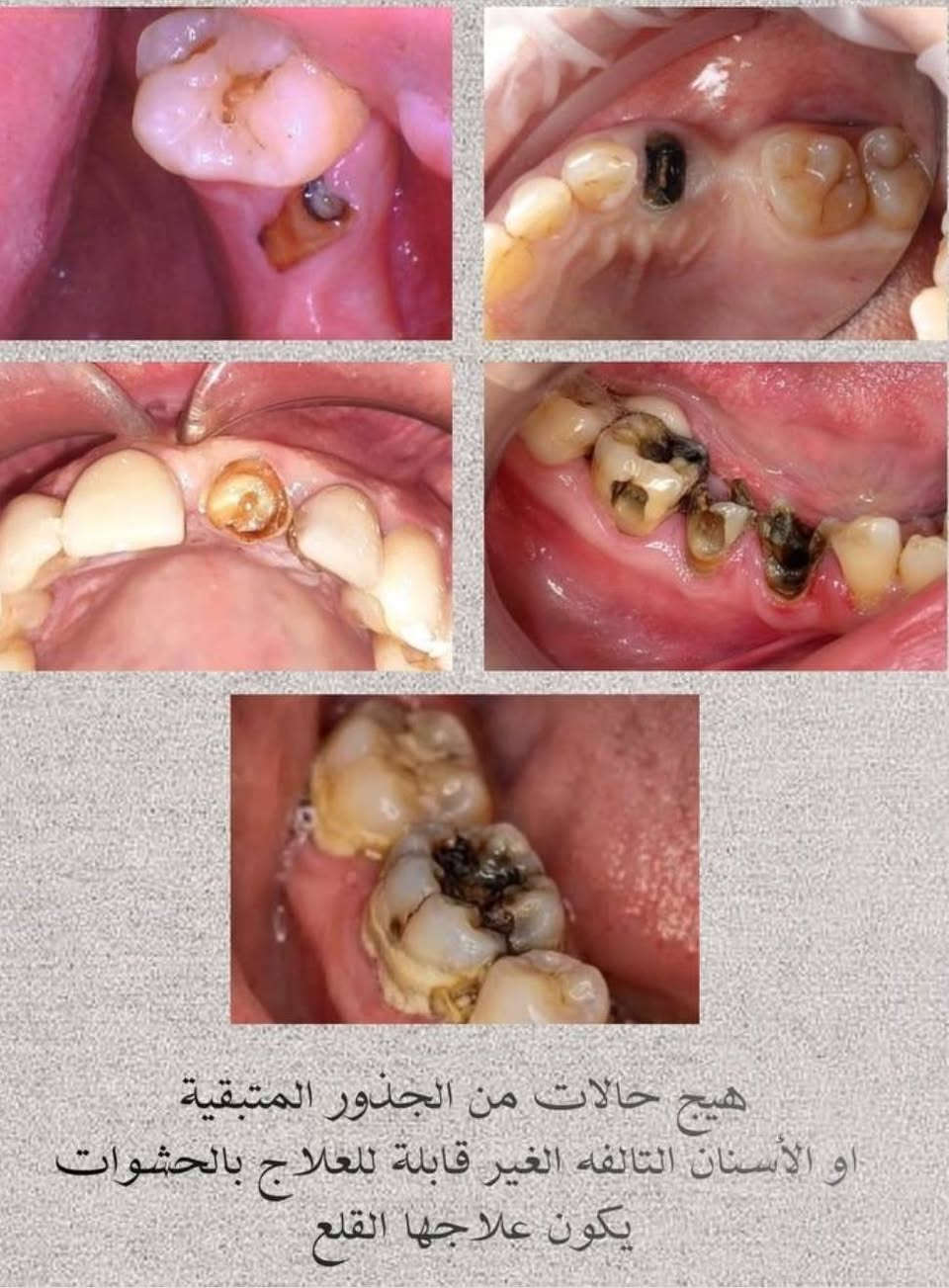 الدورة نهاية شارع ستين • تنظيف اسنان • قلع اسنان