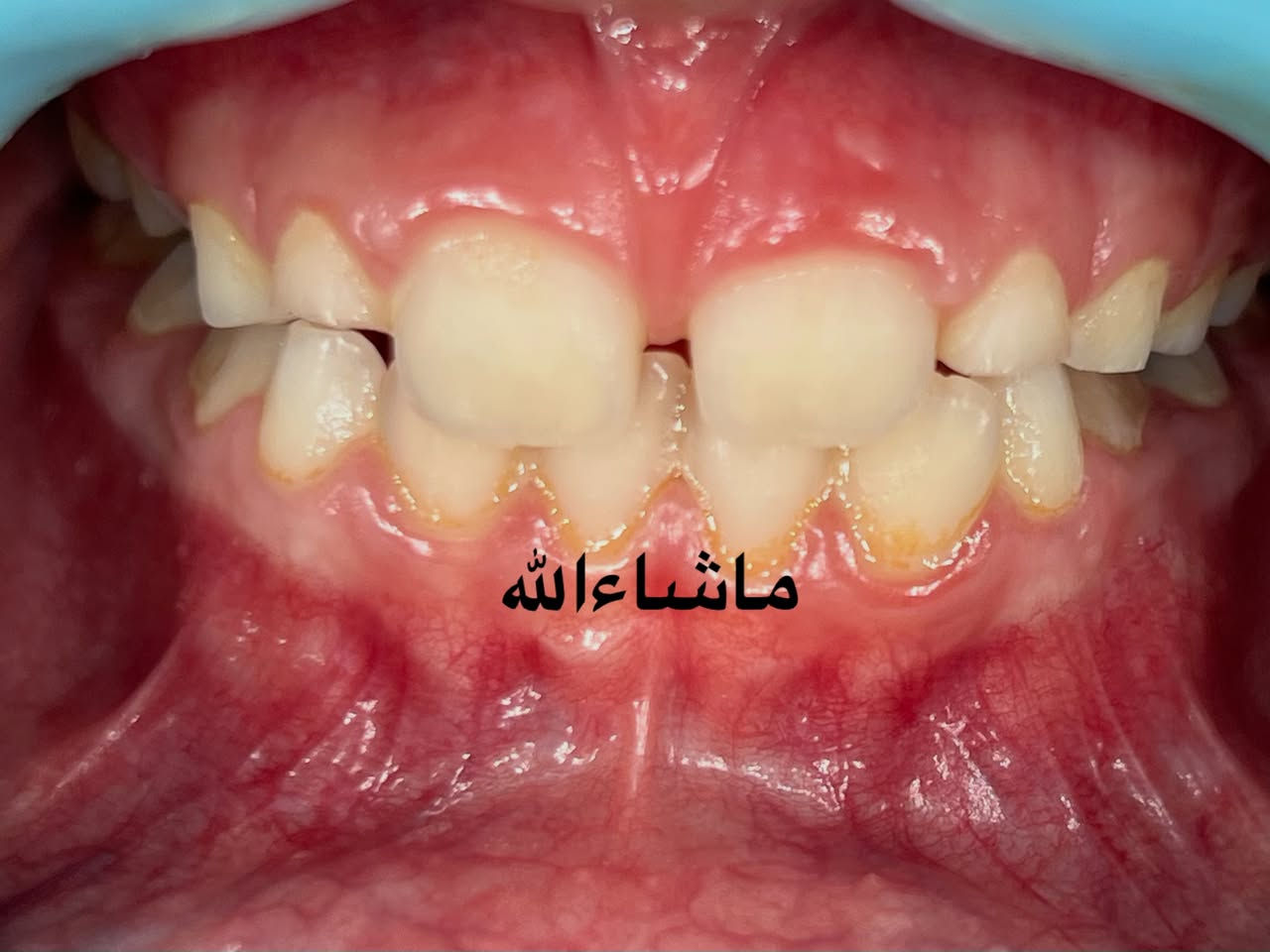 تقويم الأسنان • تقدم الفك السفلي • نفق الشرطة