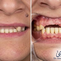 عيادات النخبة • زاركون ألماني • فلر شفايف