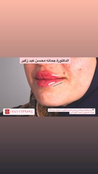 فلر الشفة • تجميل شفايف • واسط حي الوحدة