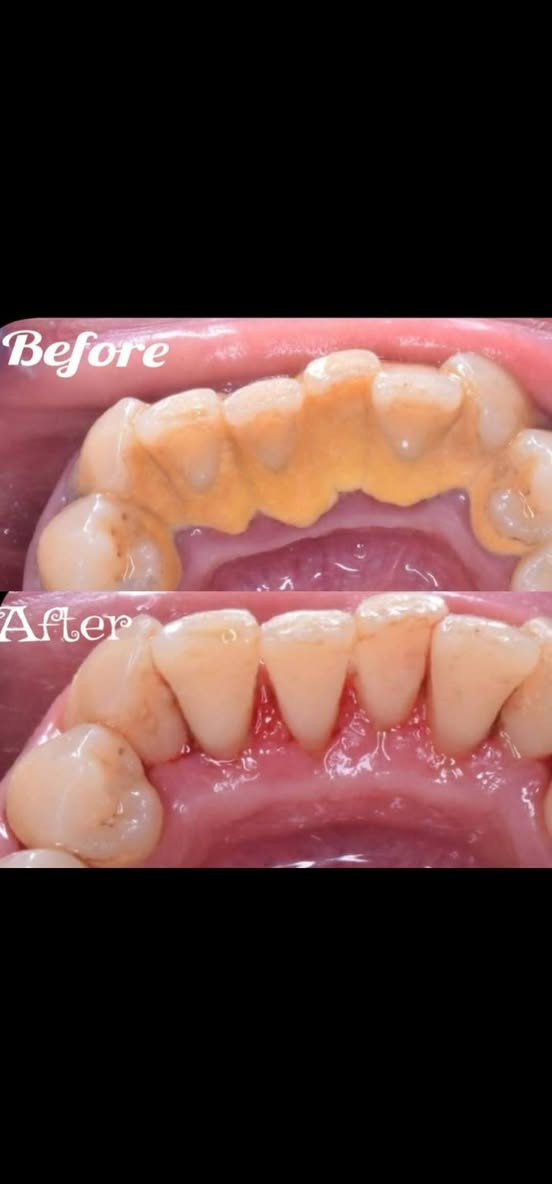 الي عنده هيج تكلسات يراسلني علاج مجانا 
***********

نص مكتوب في الصور:
- Before After