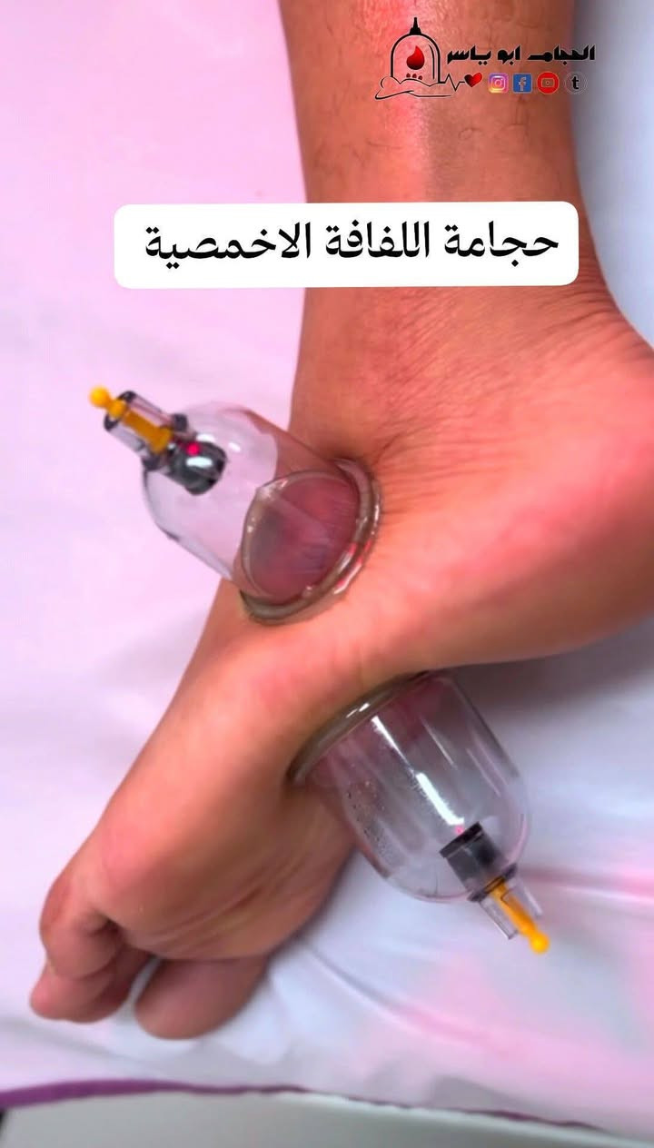 حجامة • مساج • علاج عرق النسا