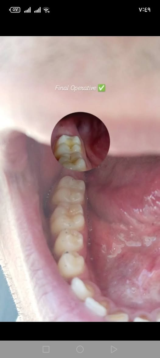 السلام عليكم اني مرحلة خامسة طب اسنان كليتي في باب المعظم استلم حالات القلع والحشوات وعلاج التهاب اللثة والتكلسات الي يحب يتواصل وياي *********** واتساب

وهذا جزء من #شغلي من كنت بل #رابع وشكرا

الموقع #باب_المعظم كلية اصول العلم .

نص مكتوب في الصور:
- Final Operative